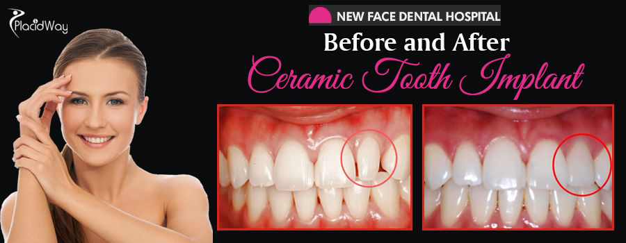 Before and After Ceramic Tooth Implant South Korea
